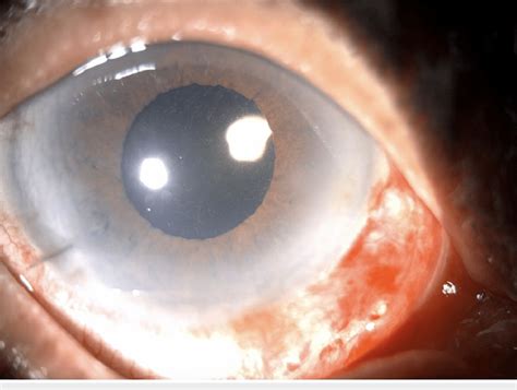 A Slit Lamp Photo Of The Operated Eye In The First Postoperative Visit