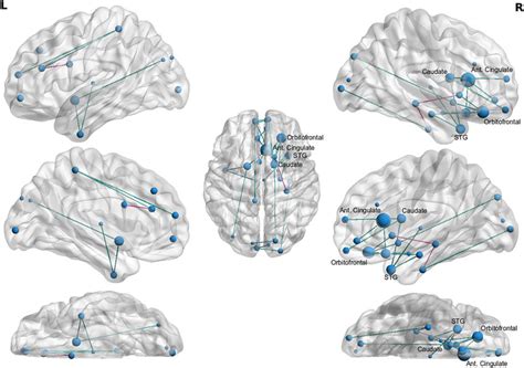 Network Based Statistic Identified Dti Structural Connectivity Network Download Scientific