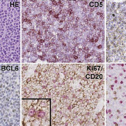 Histology of lymph node infiltrated by B-CLL cells. Ubiquitously ...