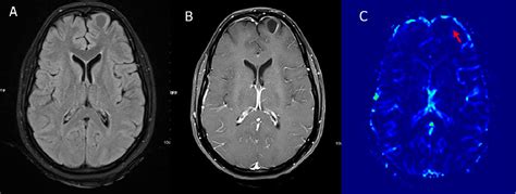 Figure 13 From A Residents Guide To Perfusion Mri In Intracranial Space