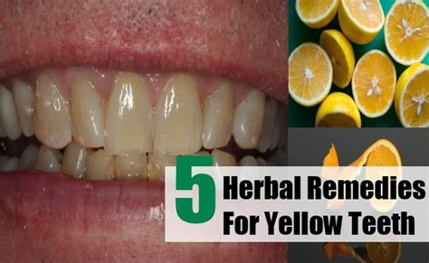 TOP 5 HERBAL REMEDIES FOR YELLOW TEETH ~ Mzizi Mkavu