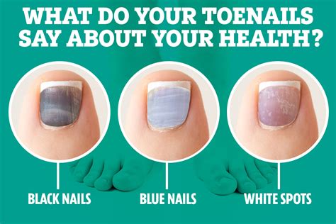 White Discoloration On Toenails After Nail Polish Nail Ftempo