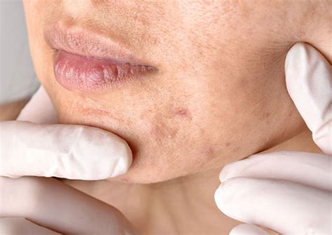 Cost Of Tca Cross For Acne Scars