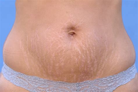 Stretch Marks Removal Help Striae Treatments Novuskin