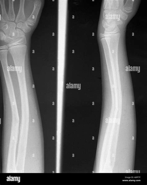 X Ray Greenstick Fractura De Radio Y C Bito Arqueamiento De Fotograf A