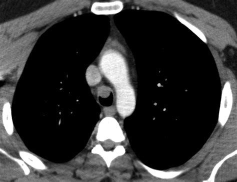 Airp Best Cases In Radiologic Pathologic Correlation Adenoid Cystic Carcinoma Of The Trachea