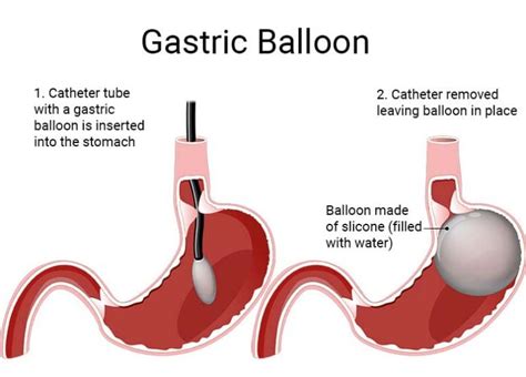 Gastric Balloon Op Dr Mehtap ErtÜrk