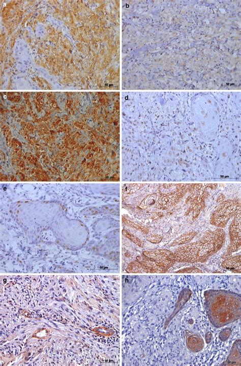 Photomicrograph Of Immunohistochemical Staining Of Granular Cell Tumor