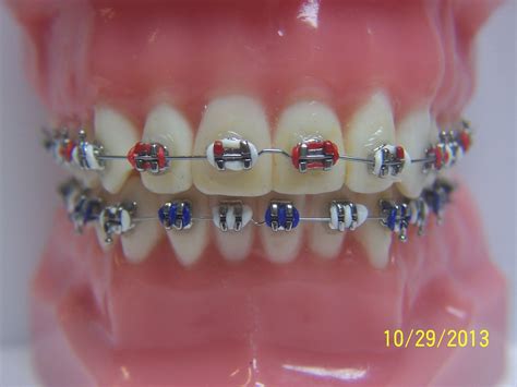 bloggingforfun6395: Metal Braces Bracket Colors