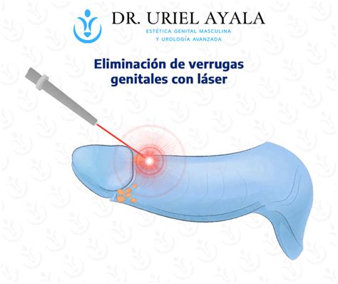 Eliminaci N De Verrugas Genitales Rologo Dr Uriel Ayala