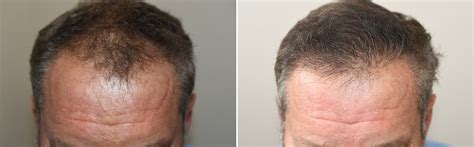 Hair Transplants For Men Photos Miami Fl Patient125931