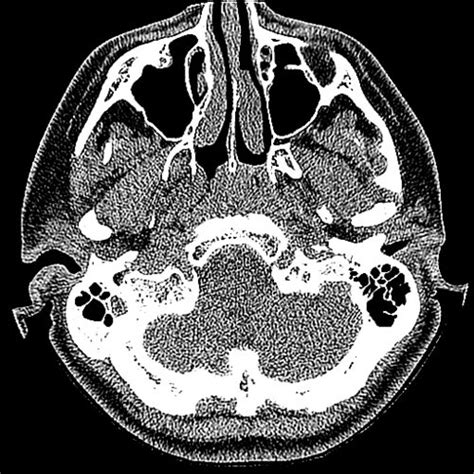 CT Scan ear - democratiz3D® Processing - embodi3D.com