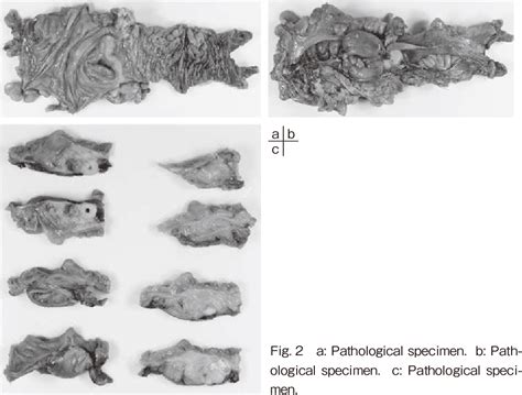 figure    case  goblet cell carcinoid  peritoneal