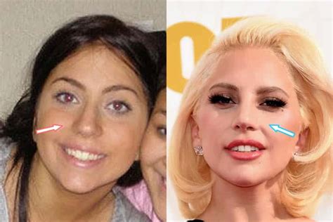 Does Lady Gaga Have Plastic Surgery Before After