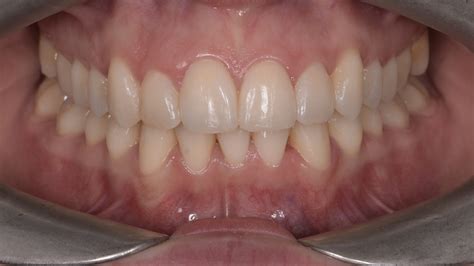 Lower Incisor Extraction Case — E Line Orthodontics