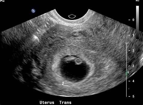 Great Health: Gestational Sac