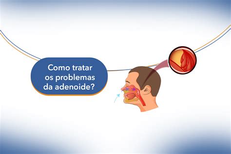 Como Tratar Os Principais Problemas Da Adenoide Hospital Paulista