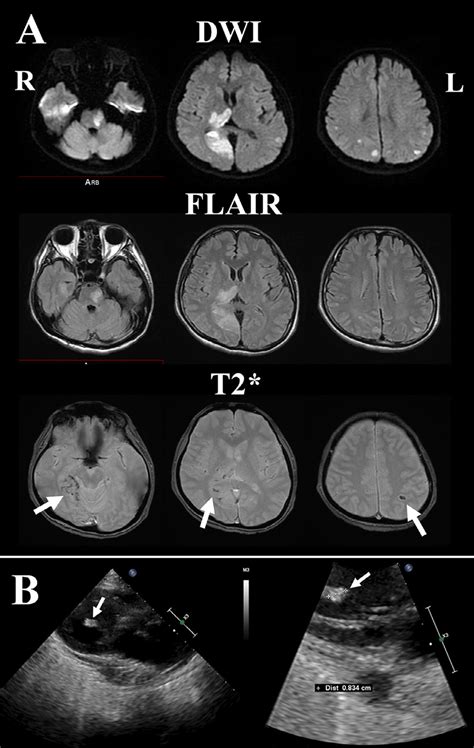 A Magnetic Resonance Imaging On Admission Diffusion Weighted Images