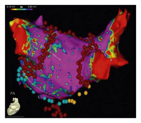 Endocardial 3 Dimensional Voltage Mapping And Catheter Ablation Lesion