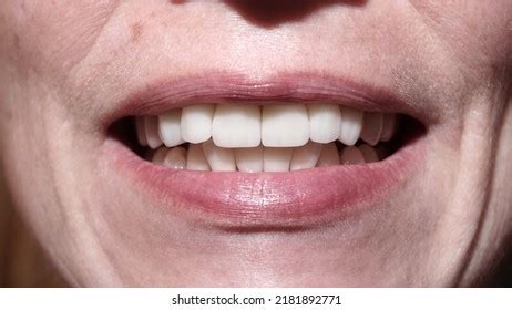 Teeth After Caries Treatment Woman Veneers Stock Photo 2181892771