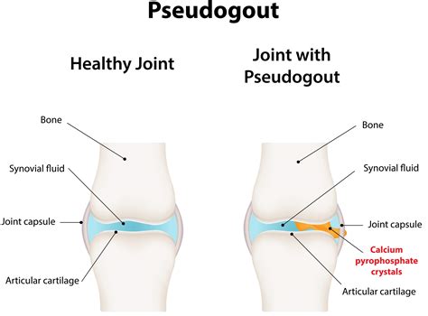 Gout Crystals In Knee
