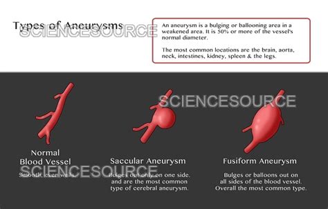 Photograph Types Of Aneurysms Science Source Images