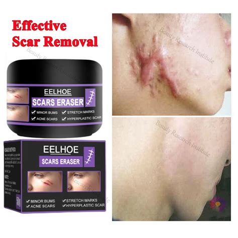 Scar Remover Peklat Remover Cream Original Acne Surgery Scar Insect