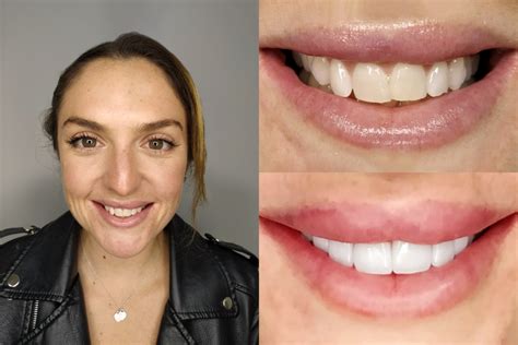 Full Mouth Reconstruction V3 Allo Dental