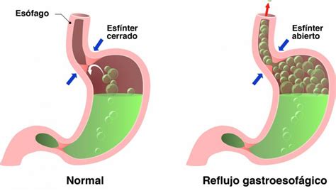 REFLUJO GASTROESOFÁGİCO BIOGEO MIGUEL DELIBES