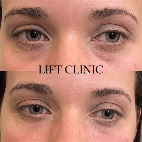 Dermal Fillers Before And After Lift Clinic Toronto