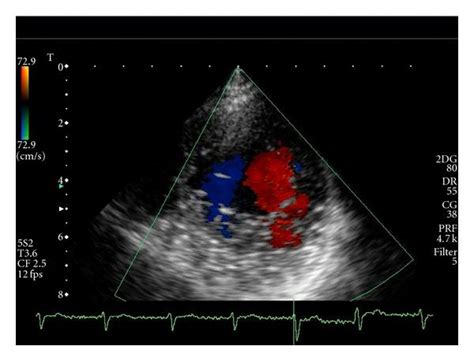 Transthoracic Doppler Echocardiography Short Axis View The