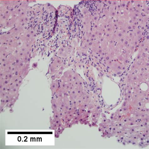 Primary Biliary Cholangitis Libre Pathology