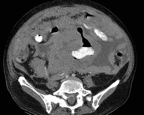 Small Bowel | Radiology Key