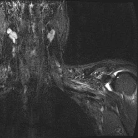 Brachial Plexus Root Avulsion Radiology Case Radiopaedia Org