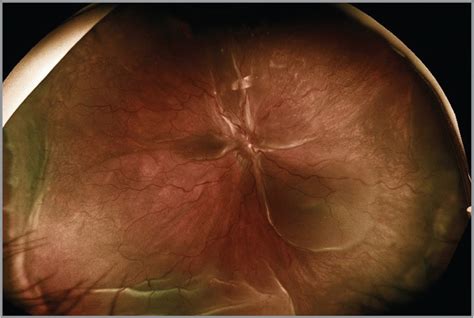 Posterior Scleritis Ophthalmic Surgery Lasers And Imaging Retina