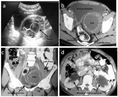 Cystic Schwannoma Of The Pelvis The Annals Of The Royal College Of