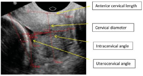 Transvaginal Sonographic Example Of Uterocervical Intracervical Angle