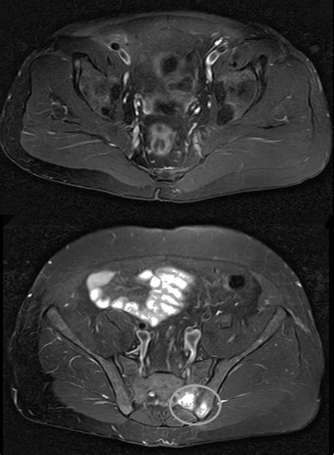 Figure 3 From Sacroiliitis And Gluteal Abscess Secondary To