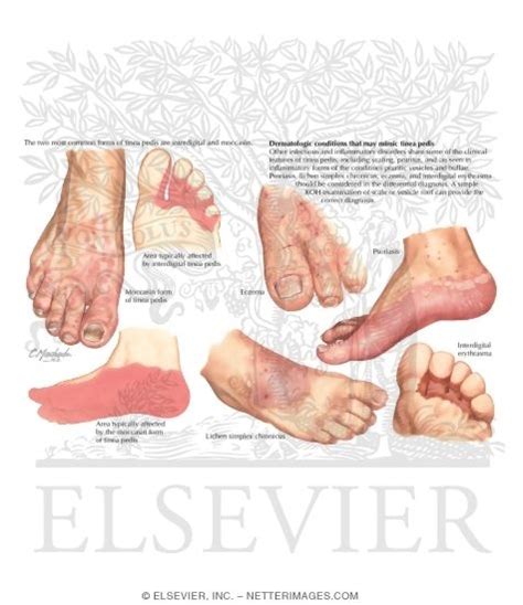 Diagnosis of Tinea Pedis