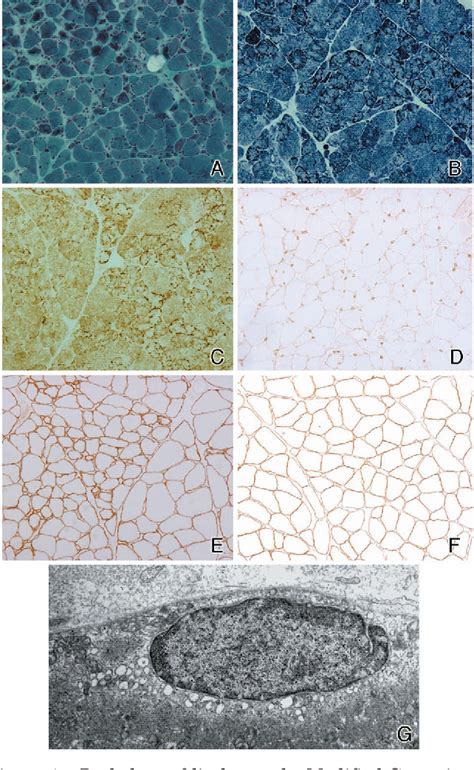 Figure 1 From Progressive Myopathy With Circulating Autoantibody