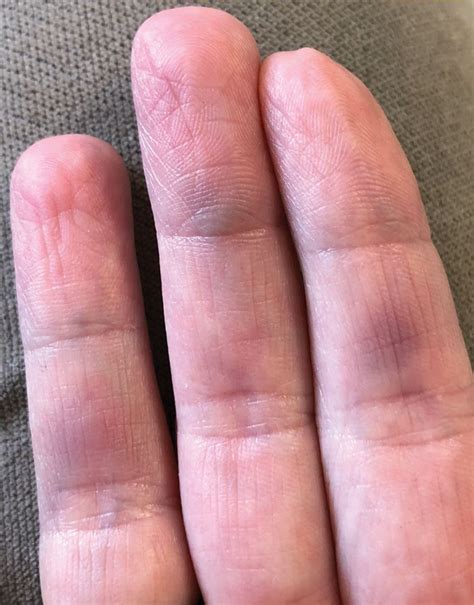 Paroxysmal Finger Hematoma Cleveland Clinic Journal Of Medicine