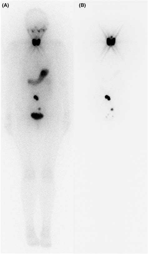 A I Scintigraphy With Mbq Anterior View H After Injection