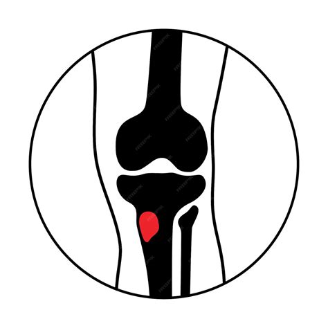 Enfermedad De Osteomielitis Dolor De Huesos Muertos De Rodilla