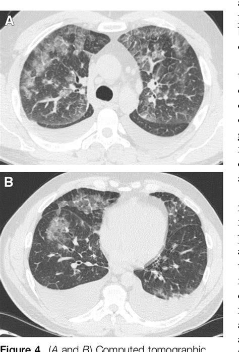 Acute Eosinophilic Pneumonia. Causes, Diagnosis, and Management ...