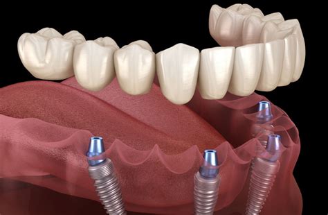 How Long Do Dental Implants Last