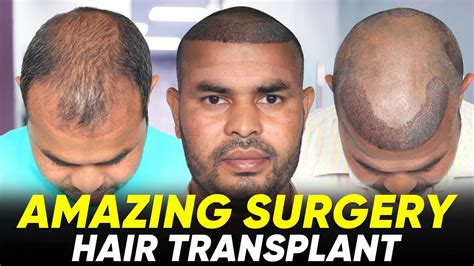 Hair Transplant In Jalandhar Best Results Cost Of Hair Transplant