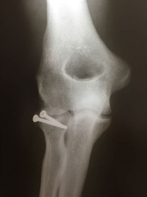 Postoperative elbow AP radiograph showing the fixation of the radial ...