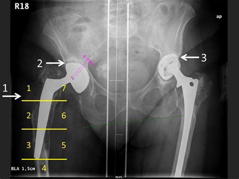 Anterior Posterior X Ray Pelvic Overview Of A 55 Year Old Woman With