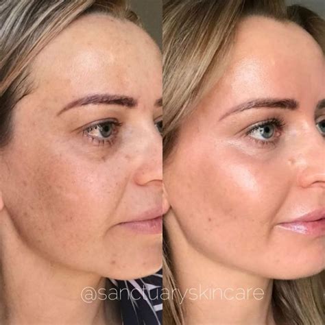 Cosmelan® Peel From 1199