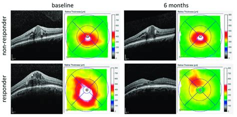 OCT images of DME patients obtained with Heidelberg Spectralis at... | Download Scientific Diagram